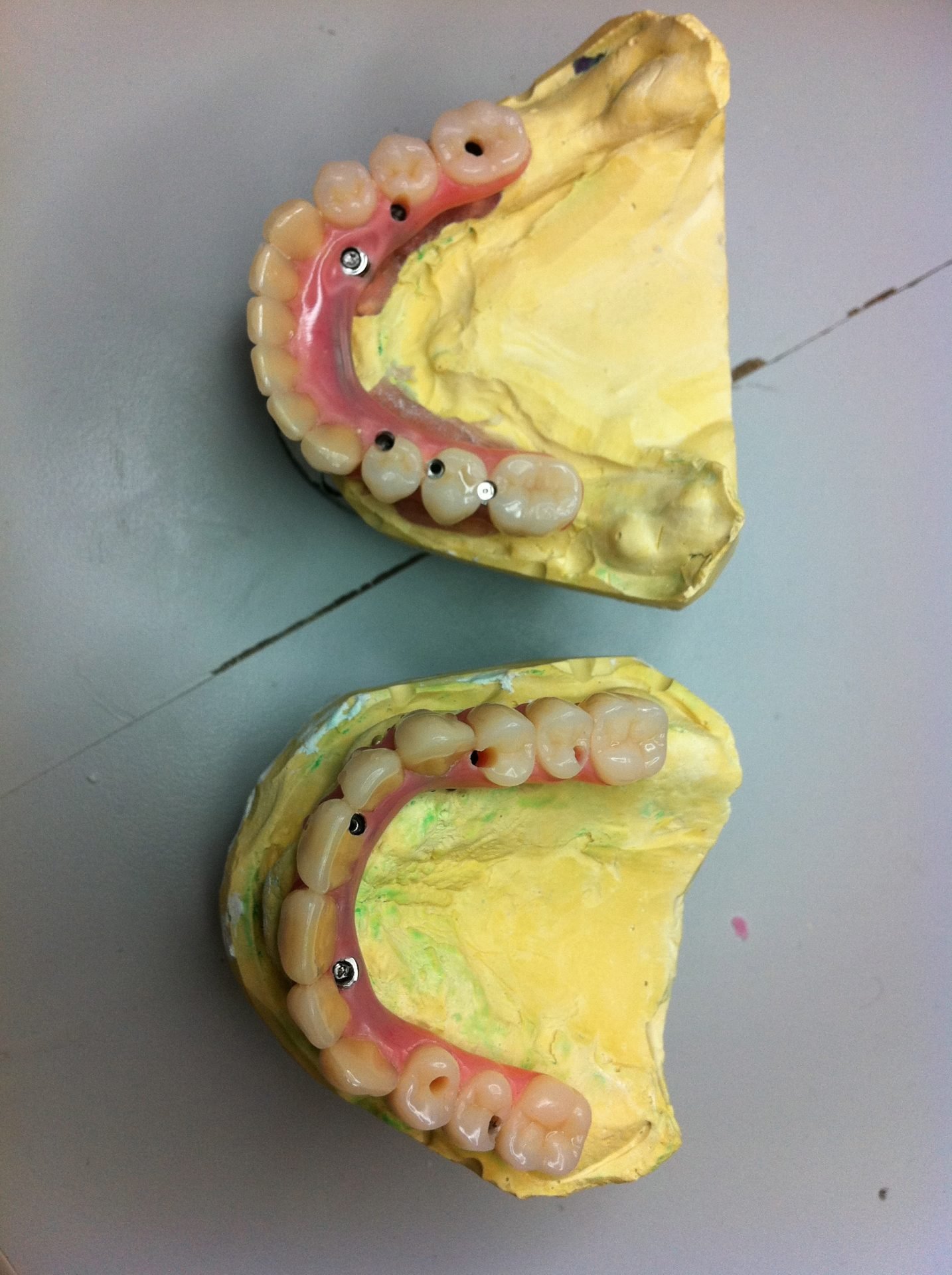 3D Printed Dental Prosthetics in Pennsylvania