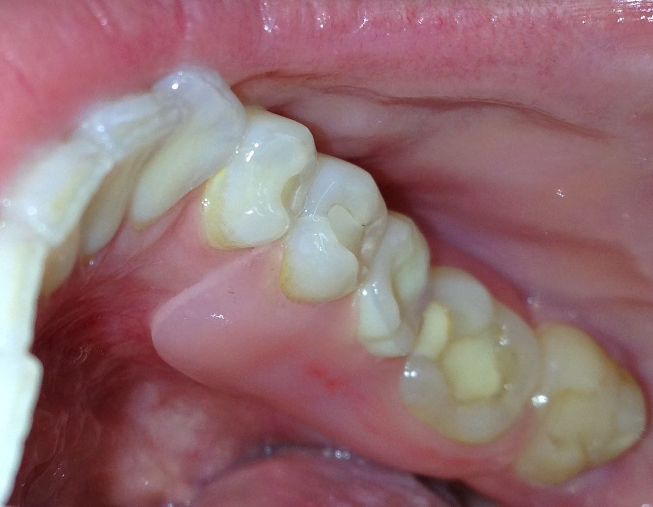 3D Printed Dental Prosthetics in Pennsylvania