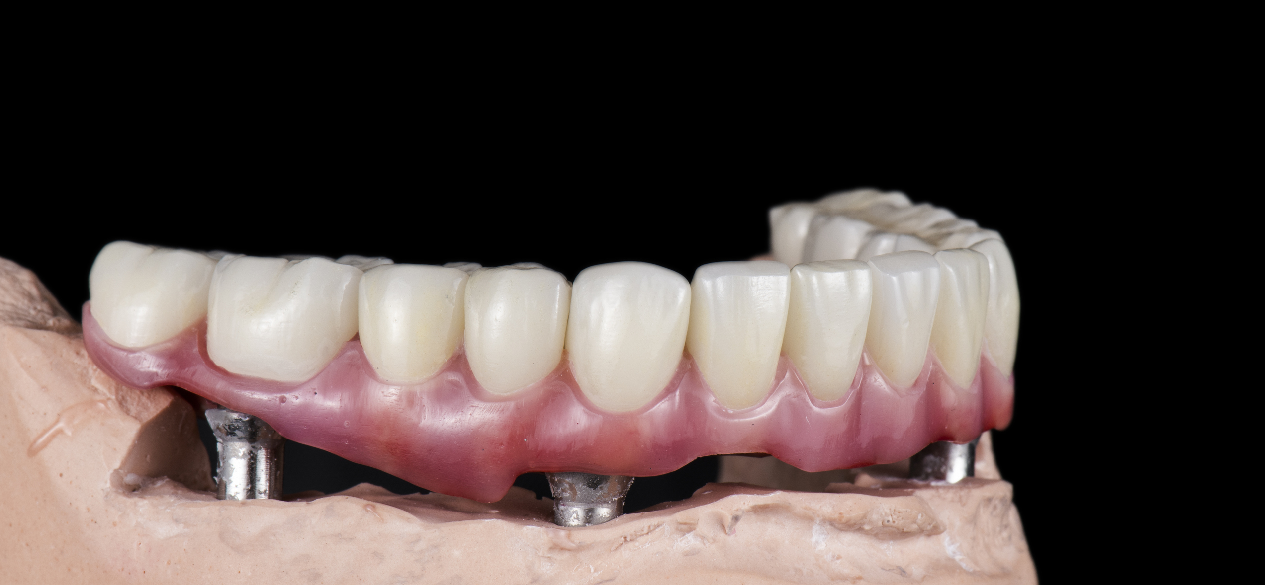 Full-arch implant prosthesis on stone model with multiple titanium abutments, All-on-4 case from Horizon Dental Lab, dental lab Warminster PA