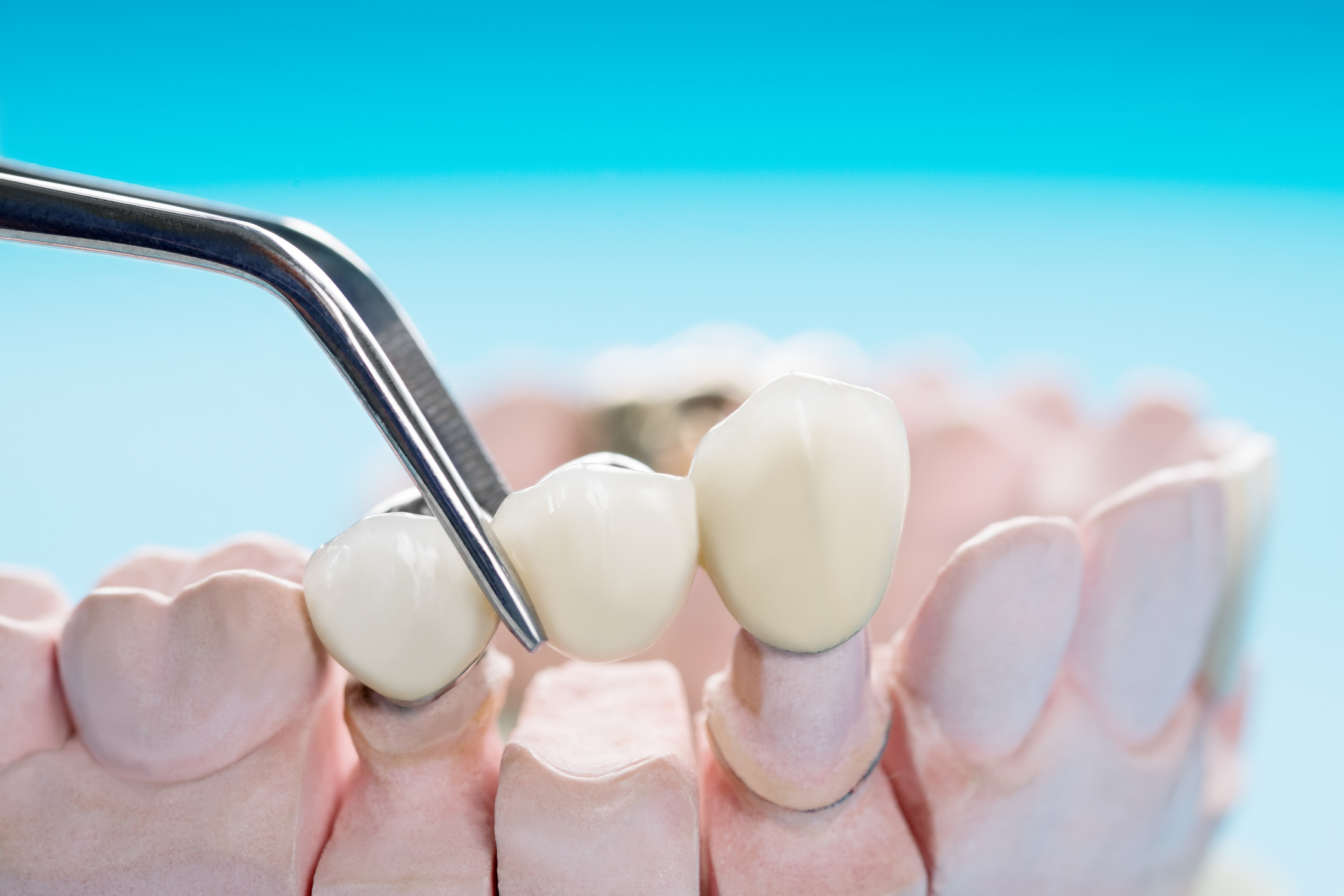 Crowns and bridges case work at Horizon Dental Lab, dental lab Warminster PA