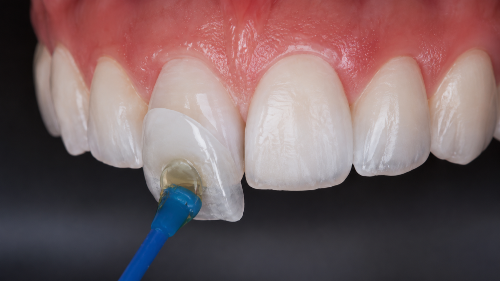 Emax (lithium disilicate) veneer being seated on a maxillary central incisor with bonding adhesive — case from Horizon Dental Lab, dental lab Warminster PA