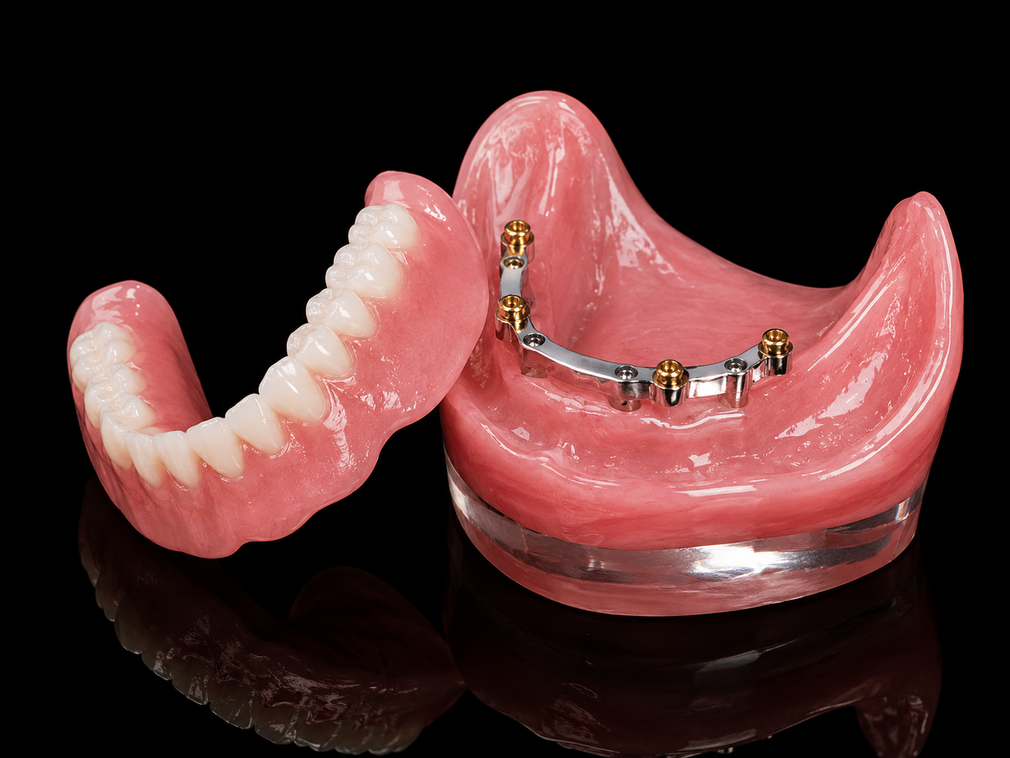 Implant Overdenture dental prosthesis fabricated by Horizon Dental Lab, Warminster PA - snap-on overdenture with locator attachment system for implant retention